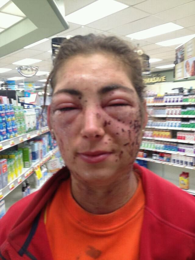 Submitted by Nico - Roughly 5 hours after, at the clinic getting tons of antihistamines and steroids